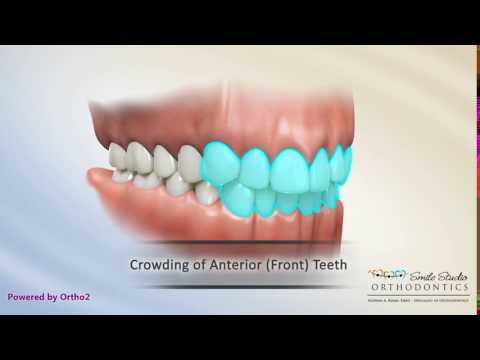 Class I Malocclusion