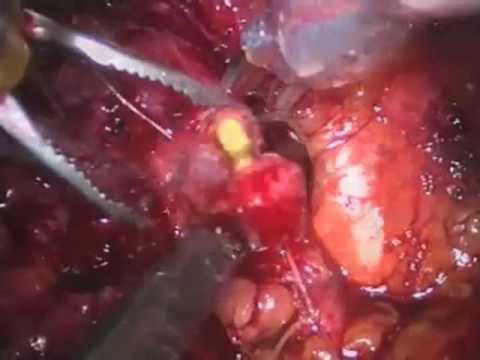 Pieloplastyka i pielolitotomia laparoskopowa w asyście robota