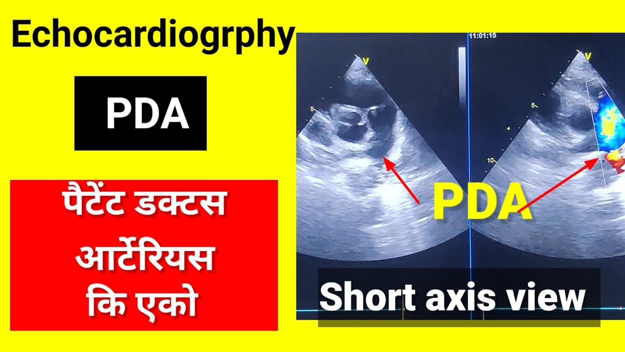 Echocardiogrphy of PDA ll Patent ductus arteriosus ll PDA echo मै कैसा दिखता है ll