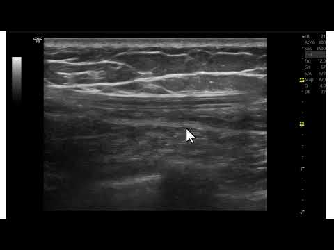 Cateter de derivação ventrículo peritoneal. Possível armadilha na ultrassonografia mamária.