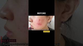 Download lagu Cara Hilangkan Jerawat & Bekas Jerawat #jerawat #bekasjerawat #acne mp3