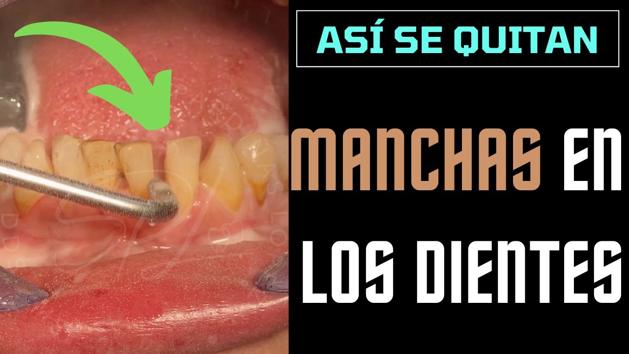 Watch Asi se quitan las MANCHAS de los DIENTES en el DENTISTA - Limpieza dental Now Asi se quitan las MANCHAS de los DIENTES en el DENTISTA - Limpieza dental