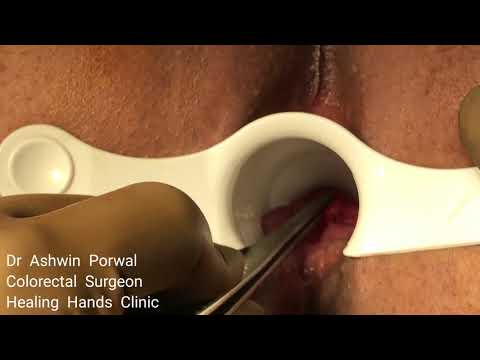 Fistula-in-Ano Treatment