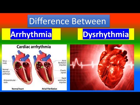 ARRHYTHMIA  Vs.  DYSRHYTHMIA