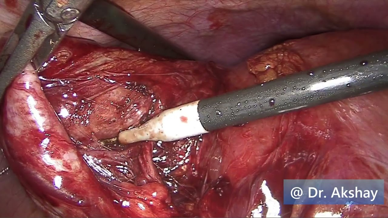 Aberrant Hepatic Artery
