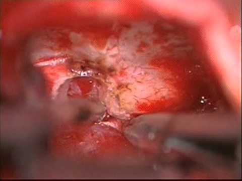 Vestibular schwannoma - Retrosigmoid approach