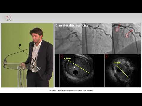Left main PCI: Do we need a purpose-built stent? - Dr Nicolas  AMABILE