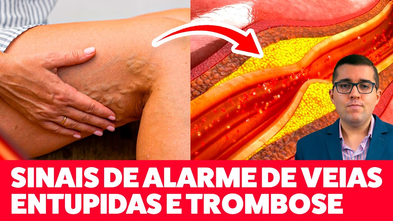 Sinais de alerta quando surge má circulação, coágulo que entope veias das pernas e embolia pulmonar