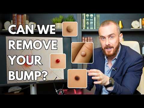 Skin Tags, Warts, Moles: Here’s What You Can Remove (And How)