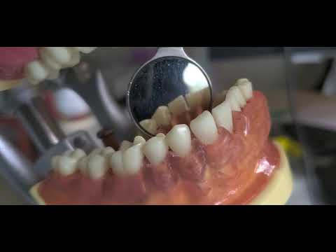 Sickles Nevi 4 & Nevi 1