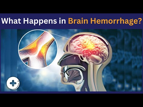 What Happens in Brain Hemorrhage | Brain Bleed Symptoms And Causes | Health Guideline