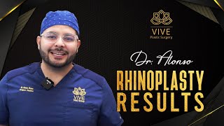 This Rhinoplasty will blow your mind! Excellent rhinoplasty Results! Dr Alonso- Vive Plastic Surgery