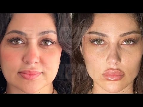 extreme facial sculpting and snatching procedure 💉 ୨୧ experimental [1x MAX]