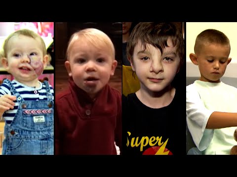 These Kids’ Lives Were Transformed by Plastic Surgery Video