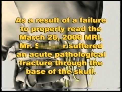 Failure to diagnose tumor at the skull base