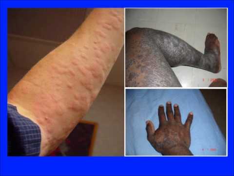 comment soulager les démangeaisons de l'urticaire