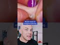 Doctor reacts to an overgrown piercing pop! #piercing #pimplepop #cystpop #dermreacts