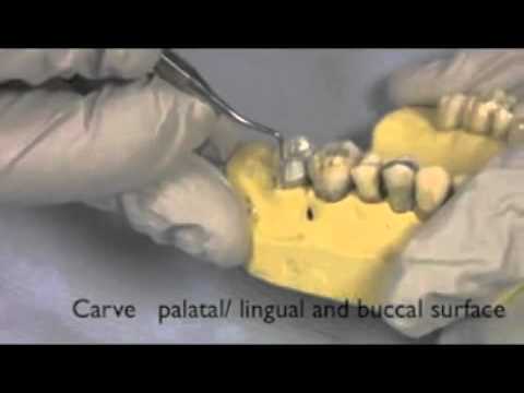 Wypełnienie amalgamatem ubytku w zębie bocznym cz 3