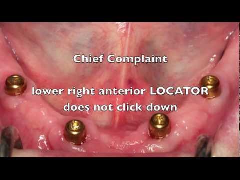 Locator Dental Implant Attachments - Workshop Tips