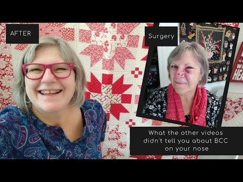 What the other videos don’t tell you about Basal Cell Carcinoma on your nose