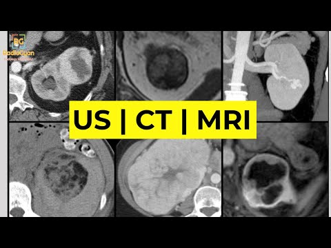 Imaging of Renal Masses [ALL YOU NEED TO KNOW] | Dr. Daniel J. Kowal (RadiologistHQ)
