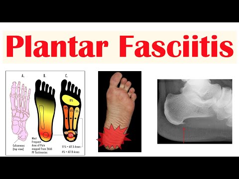 Plantar Fasciitis (Heel Pain) | Causes, Signs & Symptoms, Diagnosis, Treatment