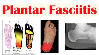 Plantar Fasciitis (Heel Pain) | Causes, Signs & Symptoms, Diagnosis, Treatment