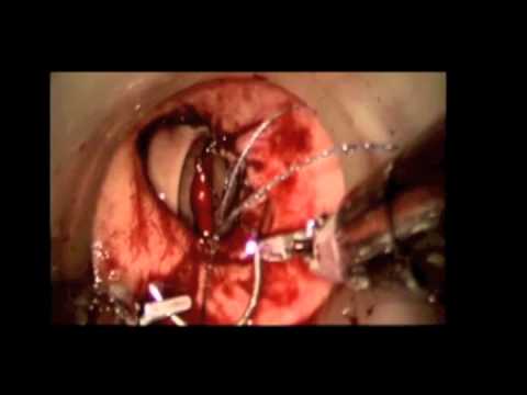 Robotic Transanal Surgery