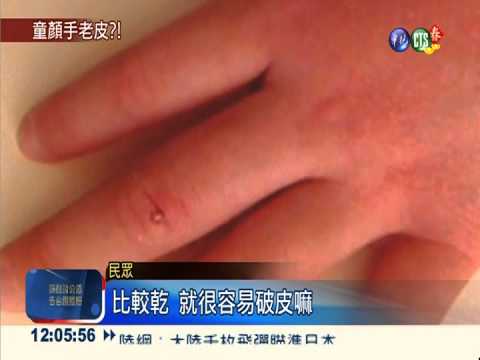 熱水洗過頭 6歲嫩手腫裂變"老"手