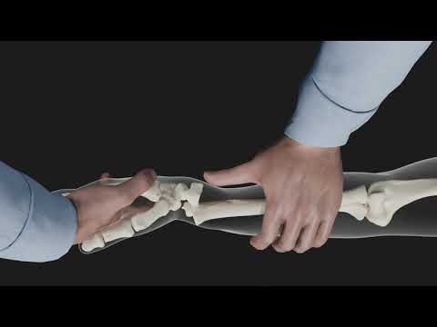 Distal Radius Closed Reduction