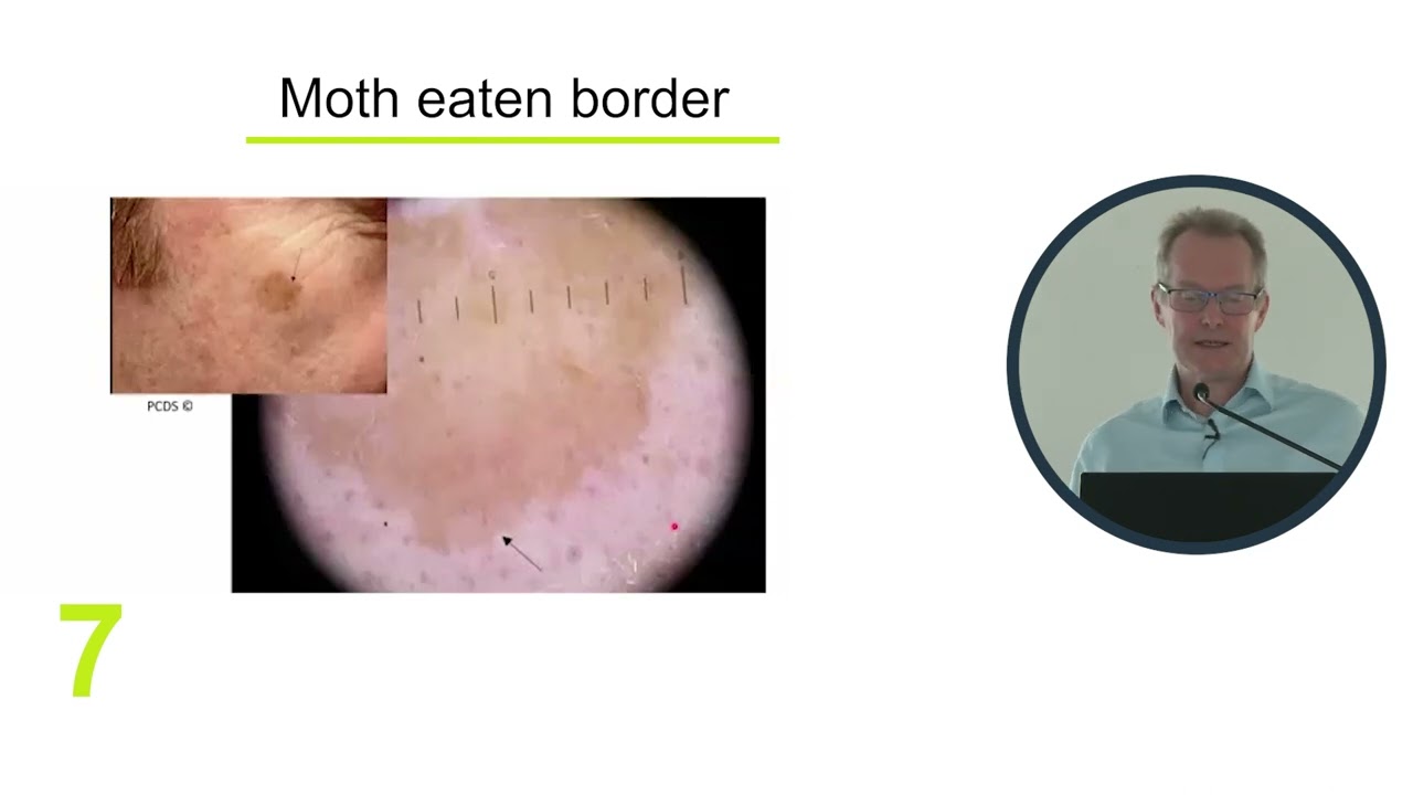 GatewayC Live: Greater Manchester &ndash; 12 Tips to Identify Seborrhoeic Keratosis