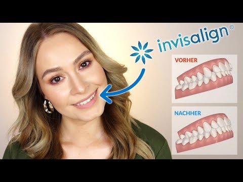Unsichtbare Zahnspange ? 😬  INVISALIGN Kosten | Erfahrung | Schmerzen