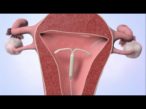 Patient Education Video: Intrauterine Device (IUD)