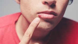 Dermatologist explains causes of cold sores