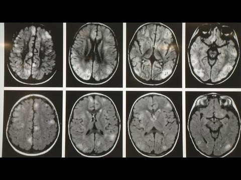 How does melanoma spread to the brain?