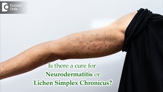 What is Neurodermatitis?: Causes, Symptoms,  Diagnosis, Treatment - Dr. Aruna Prasad