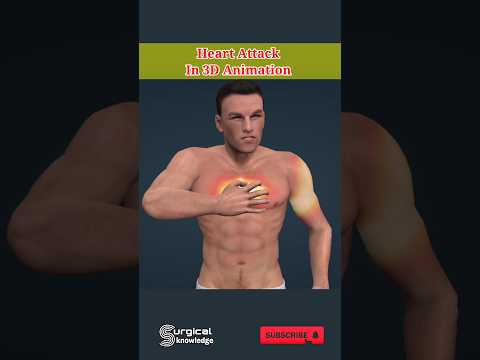 Heart Attack in 3D Animation #heartattack #animation #anatomy #medical