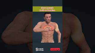 Heart Attack in 3D Animation #heartattack #animation #anatomy #medical