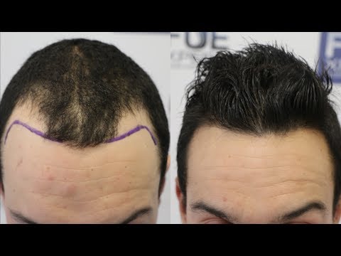 download lagu mp3 mp4 Hair Transplant Scar, download mp3 Hair Transplant Scar free download mp3, download mp3 Hair Transplant Scar