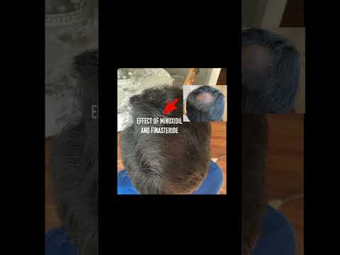 Hair Transplant Density increase without shaving and...