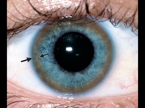 Ingwer als Behandlung von Prostatitis Wo ist die Prostata