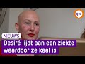 Kaal door ziekte: 'Ik dacht laat maar zitten allemaal'