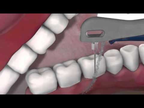 Der neue Vector Paro  Maßstab in Sachen schmerzarmer Therapie