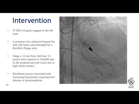 Simpson_Axillary Impella Supported PCI with Rotablation_Coronary