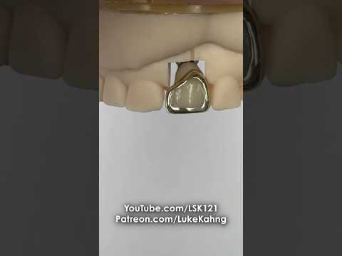 Cementing a Gold Facing #dental #teeth #smile #shorts #shortvideo #gold #implant #implants #cement