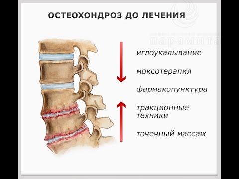 Народные средства при артрозе суставов Мрт тазобедренных суставов в перми
