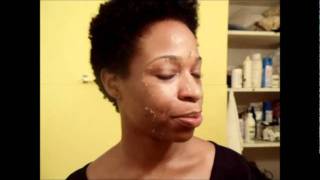 CHEMICAL PEEL DAY3 MORNING.wmv
