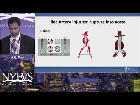 Iliac Artery Complications Management of Retroperitoneal Bleeds, Perforations, and Acute Occlusions