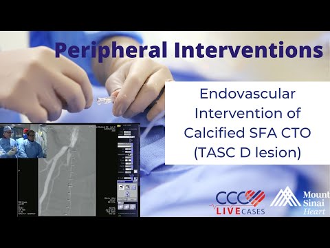 Endovascular Intervention of Calcified SFA CTO (TASC D lesion) - December 18, 2013 Live Case Video