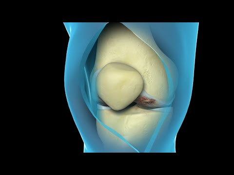 Total Knee Replacement Surgery